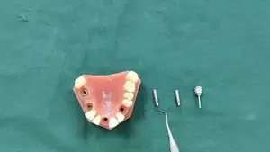 دعامة مؤقتة لنظام زرعات الأسنان BLE