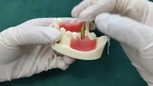 نظام الطبعة المفتوحة لزرعات الأسنان NT